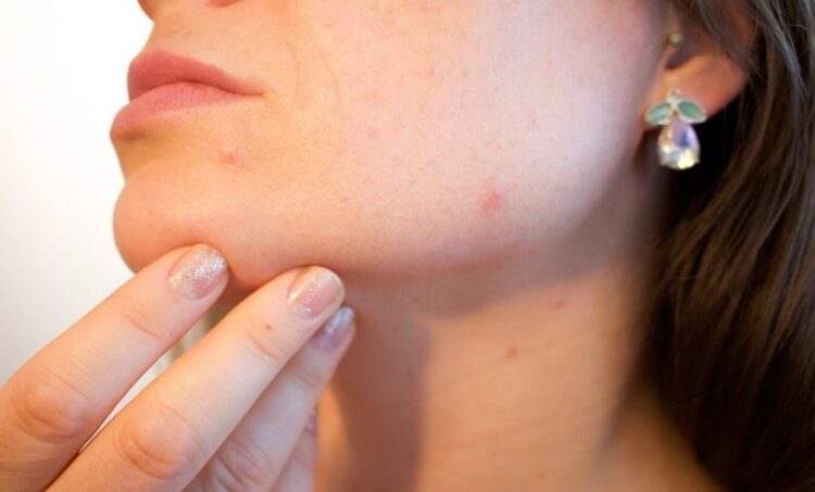 Clear Skin Awaits: Discover Acne Solutions at The Independent Pharmacy!