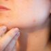 Clear Skin Awaits: Discover Acne Solutions at The Independent Pharmacy!