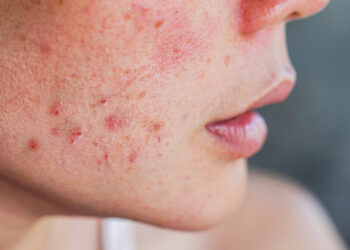 Clear Skin Confidence: The Independent Pharmacy’s Solutions for Acne