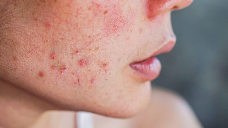 Clear Skin Confidence: The Independent Pharmacy’s Solutions for Acne