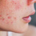 Clear Skin Confidence: The Independent Pharmacy’s Solutions for Acne
