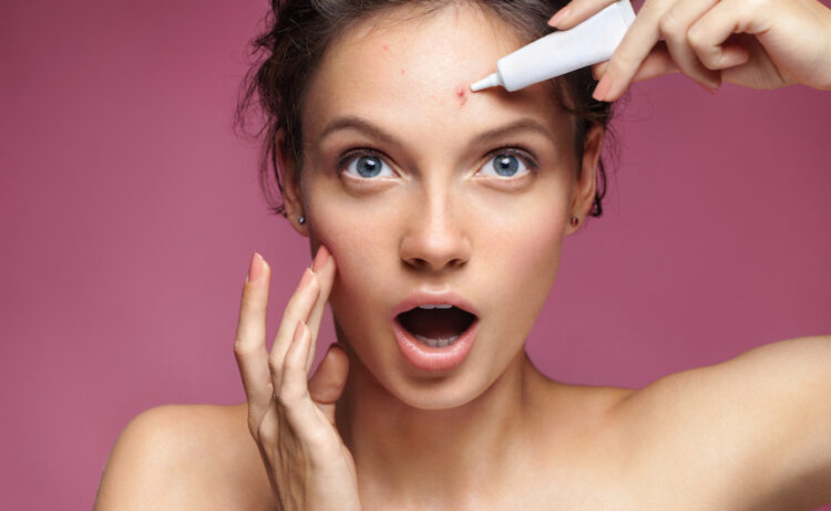 Mastering Acne: Your Guide to Effective Treatments from The Independent Pharmacy