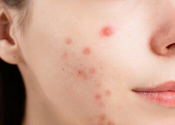 Clear Your Skin with Top Acne Solutions from The Independent Pharmacy