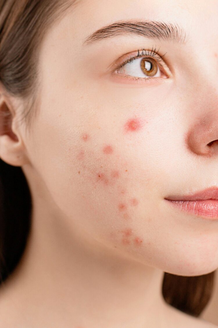 Clear Your Skin with Top Acne Solutions from The Independent Pharmacy
