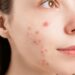Clear Your Skin with Top Acne Solutions from The Independent Pharmacy