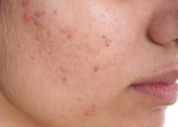Effective Acne Treatments Delivered to Your Door: Solutions from The Independent Pharmacy