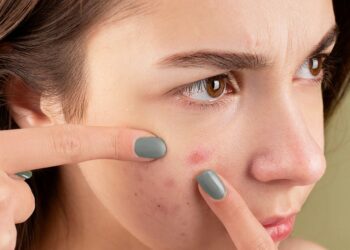 Discover the Best Acne Treatments for Long-Term Skin Clarity
