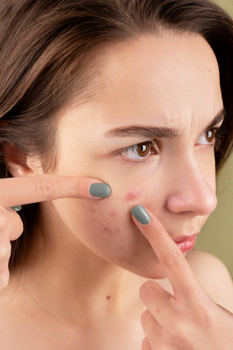 Discover the Best Acne Treatments for Long-Term Skin Clarity