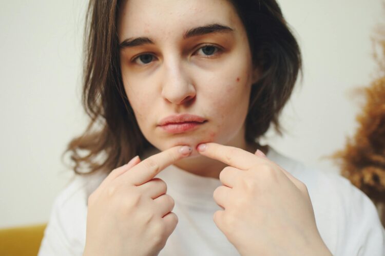 Discover the Best Skincare Solutions for Combatting Acne and Dryness